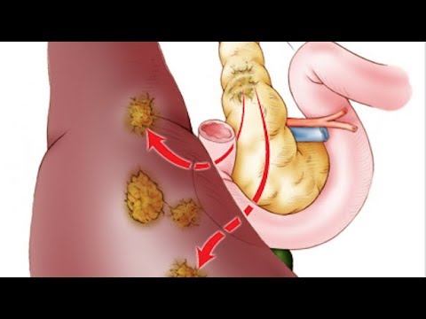 Stage 4 Pancreatic Cancer